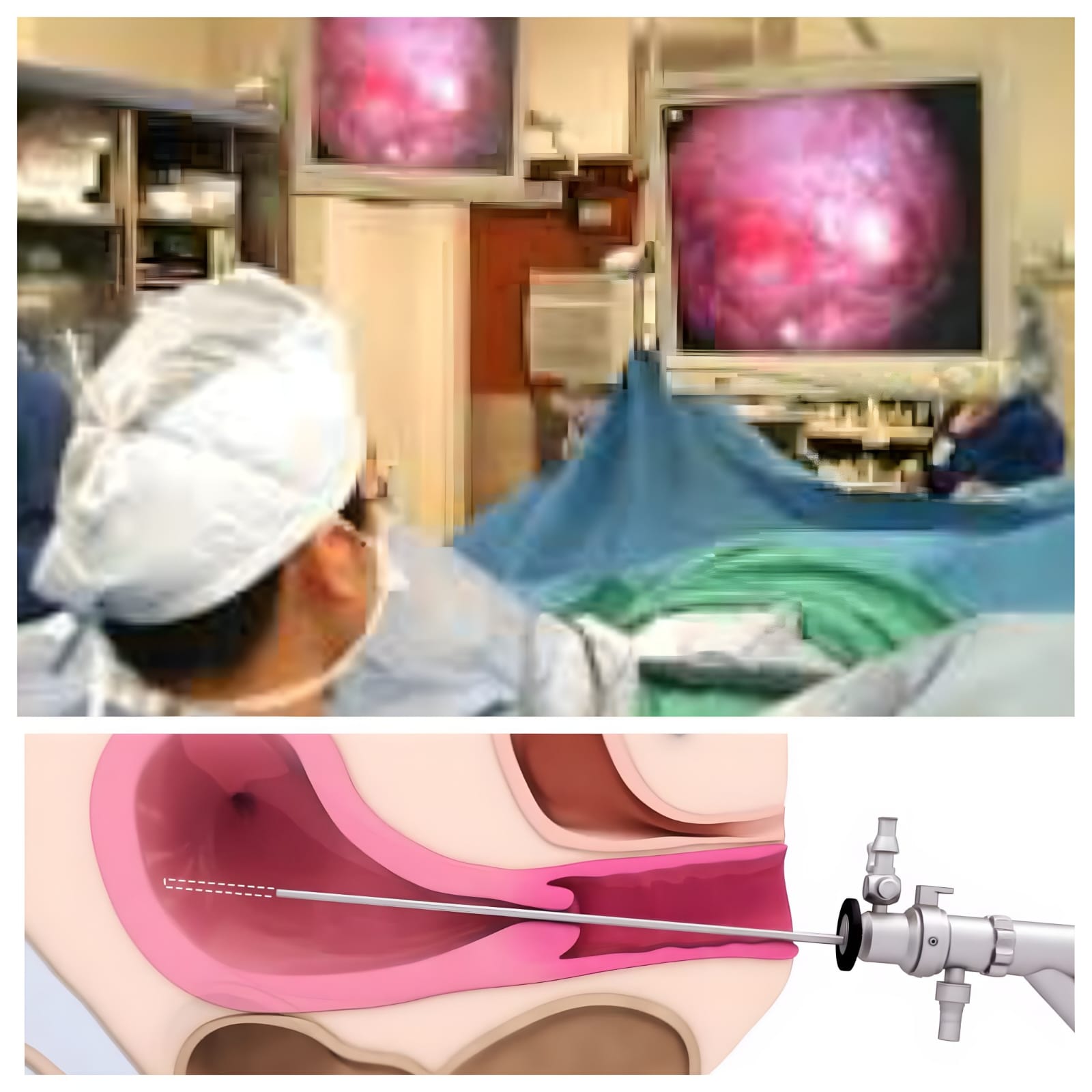 HYSTEROSCOPY : A PROCEDURE FOR UTERINE EXAMINATION