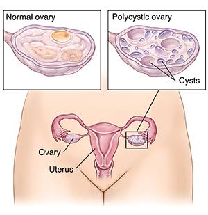 PCOD (POLYCYSTIC OVARIAN DISORDER)