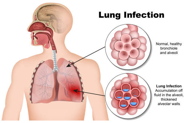 न्यूमोनिया - Pneumonia