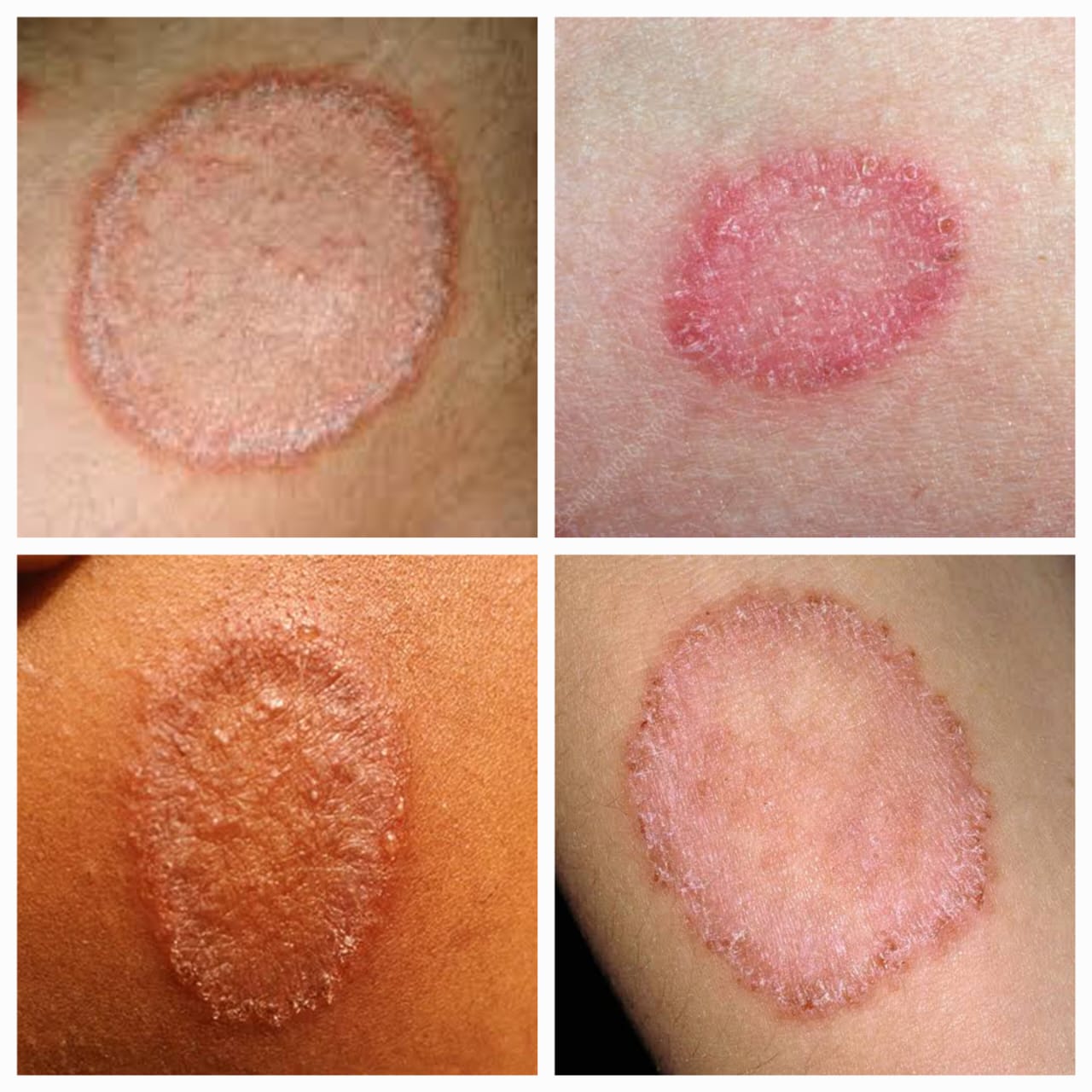 गजकर्ण नायटा (Ringworm)