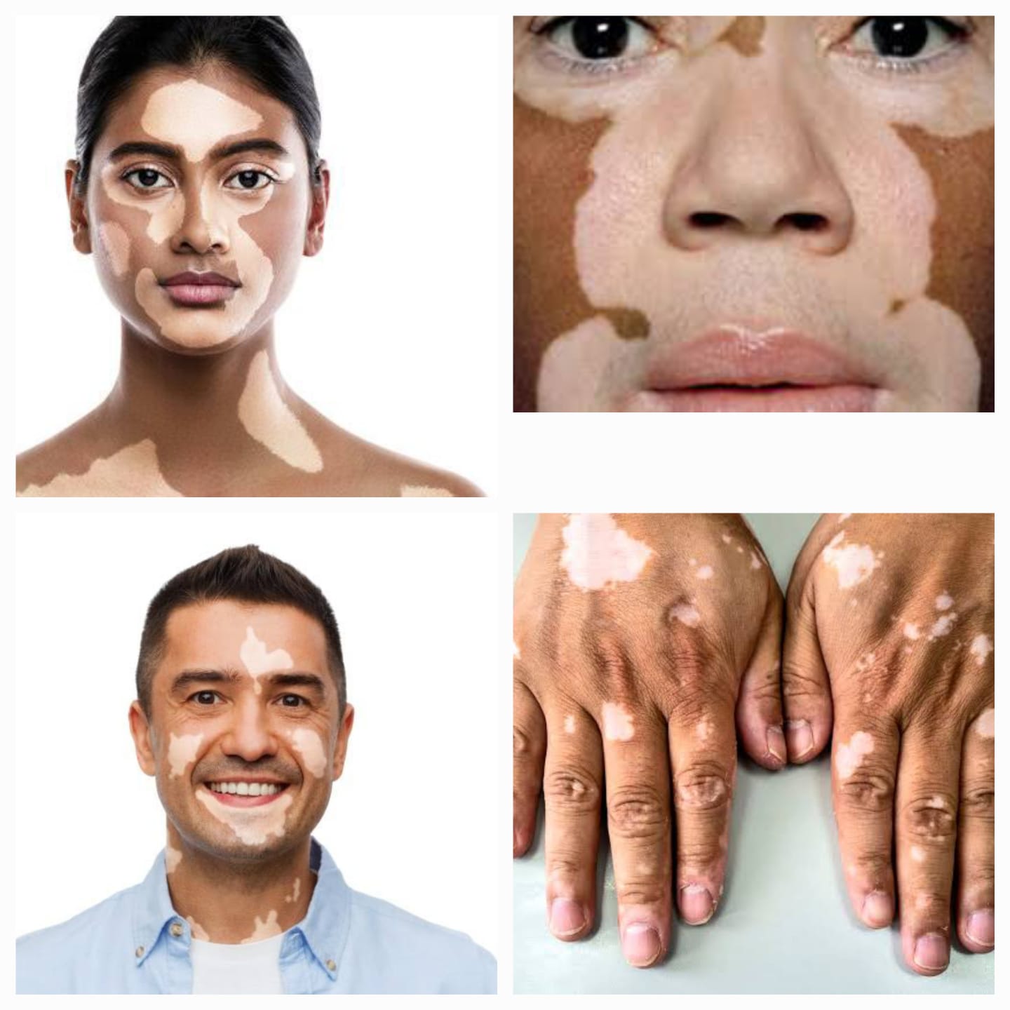 पांढरे कोड (Vitiligo)