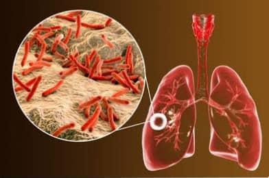 क्षयरोग – Tuberculosis