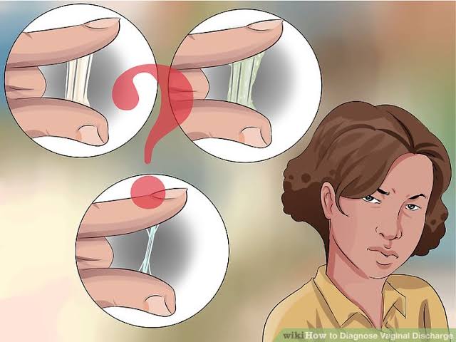 श्वेतपदर (Leukorrhea)