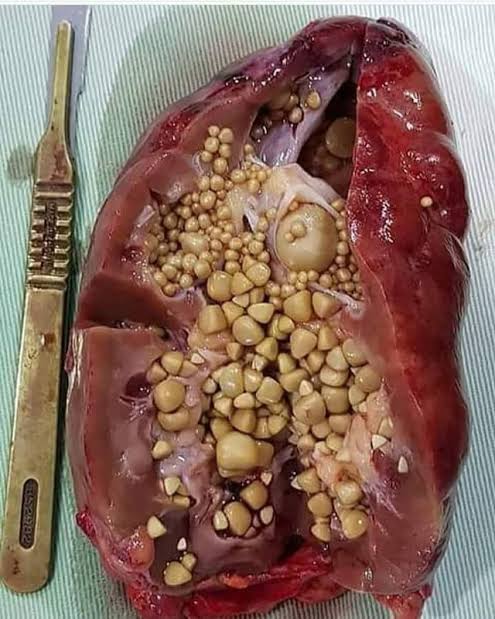पित्ताशयातील खडे (Gallstones)