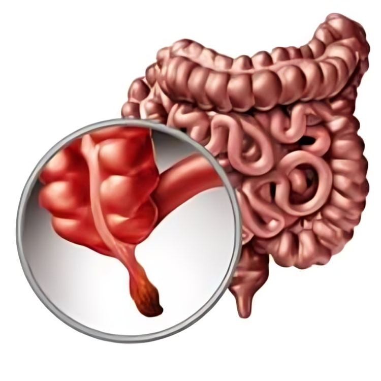 अपेंडिक्सला सूज येणे (Appendicitis)