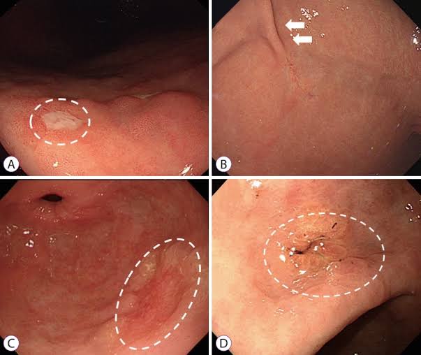 पोटाचा कॅन्सर - Stomach cancer