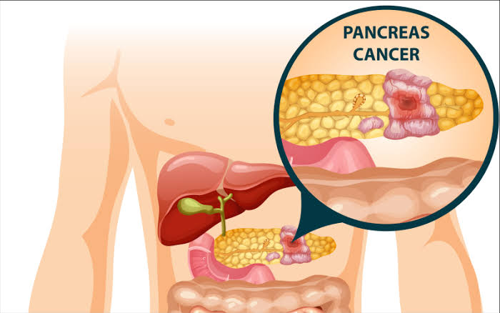 स्वादुपिंडाचा कर्करोग (Pancreatic Cancer)