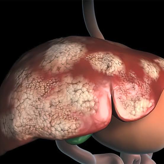 यकृताचा कर्करोग (Liver cancer)