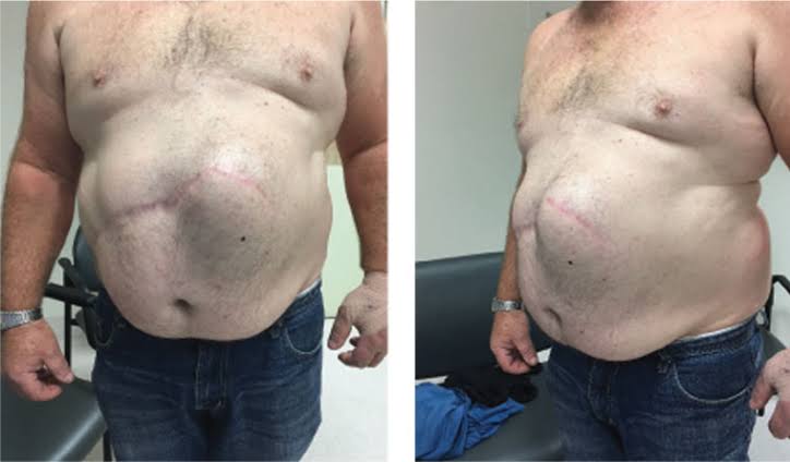 हर्निया (Hernia)