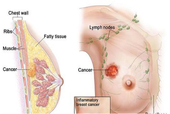 स्तनाचा कर्करोग - Breast cancer