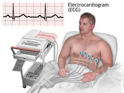 इलेक्ट्रोकार्डिओग्राम (ECG)