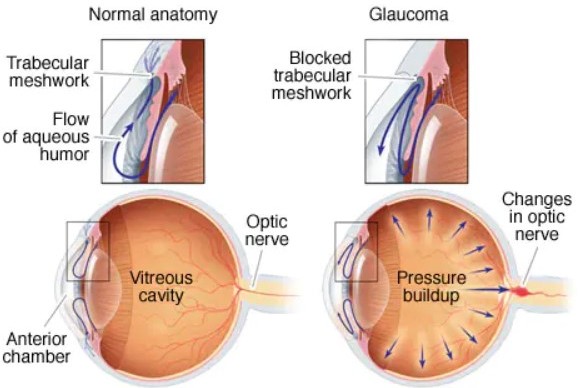 काचबिंदू (Glaucoma) आजार