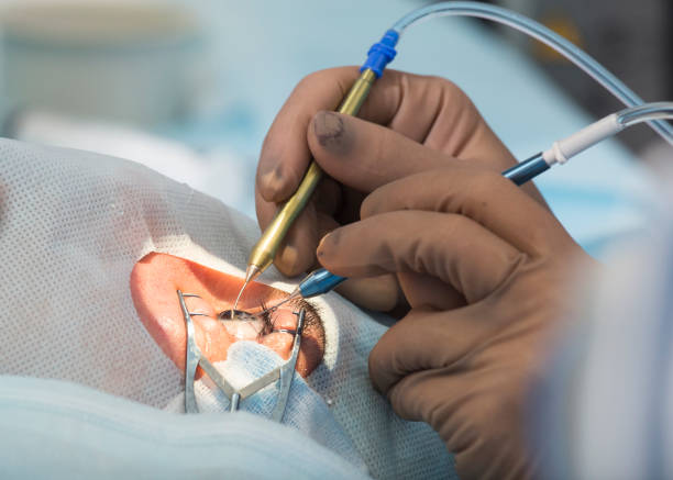 फॅको सर्जरी