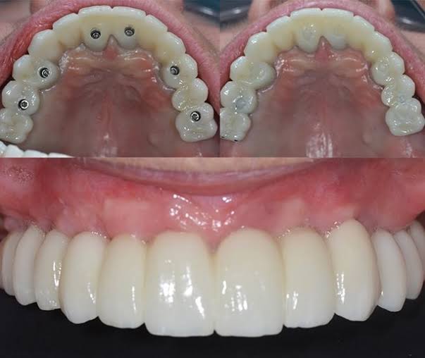 FULL MOUTH REHABILITATION