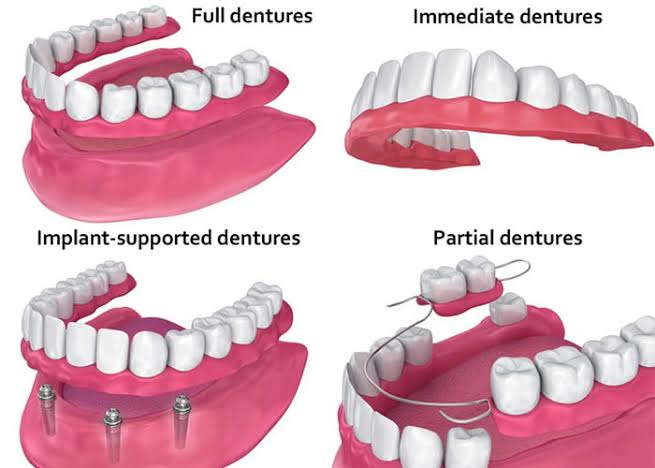 PARTIAL AND COMPLETE DENTURES