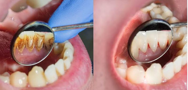 ORAL PROPHYLAXIS