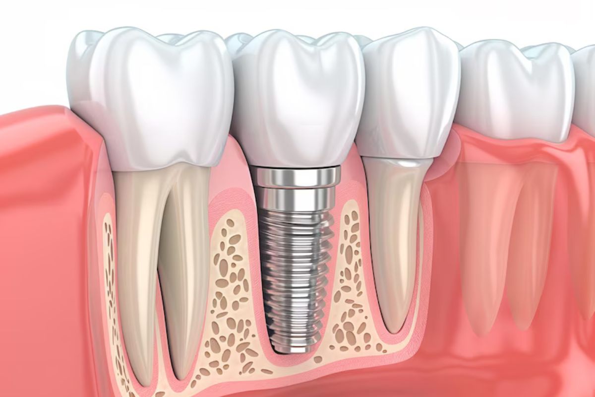 DENTAL IMPLANTS
