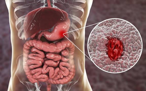 ULCER