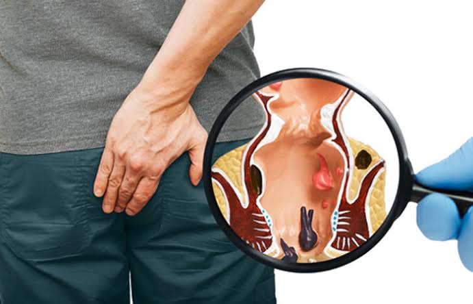 TREATMENT & SURGERY FOR PILES