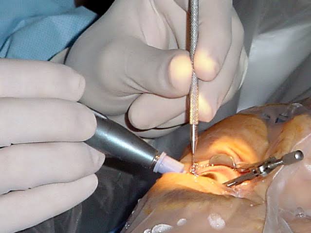 PHACO SURGERY
