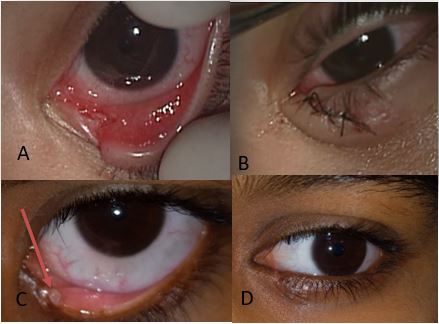 EYELID INJURY SURGERIES