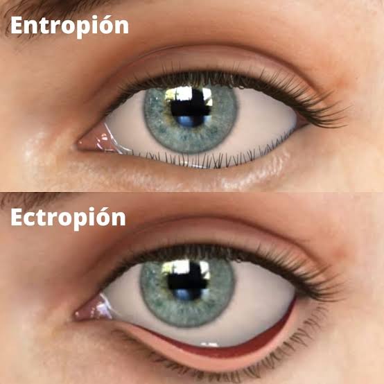 ENTROPION & ECTROPION CORRECTION SURGERIES