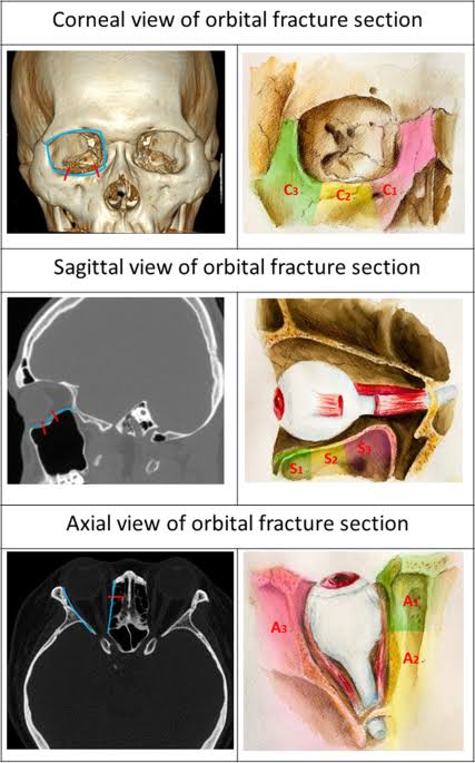 ORBITAL FRACTURE SURGERIES