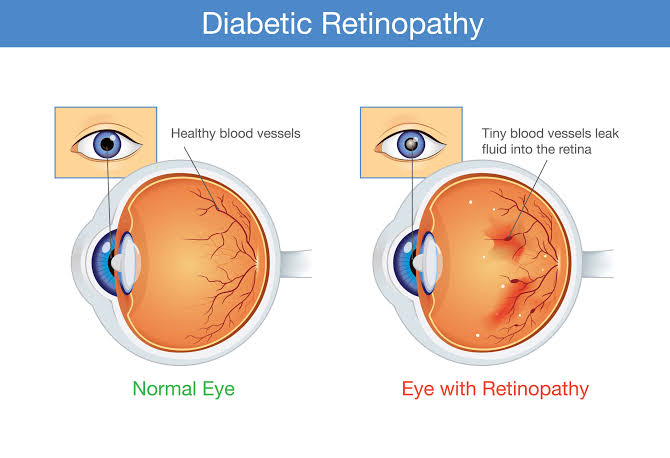 DIABETIC RETINOPATHY TREATMENT