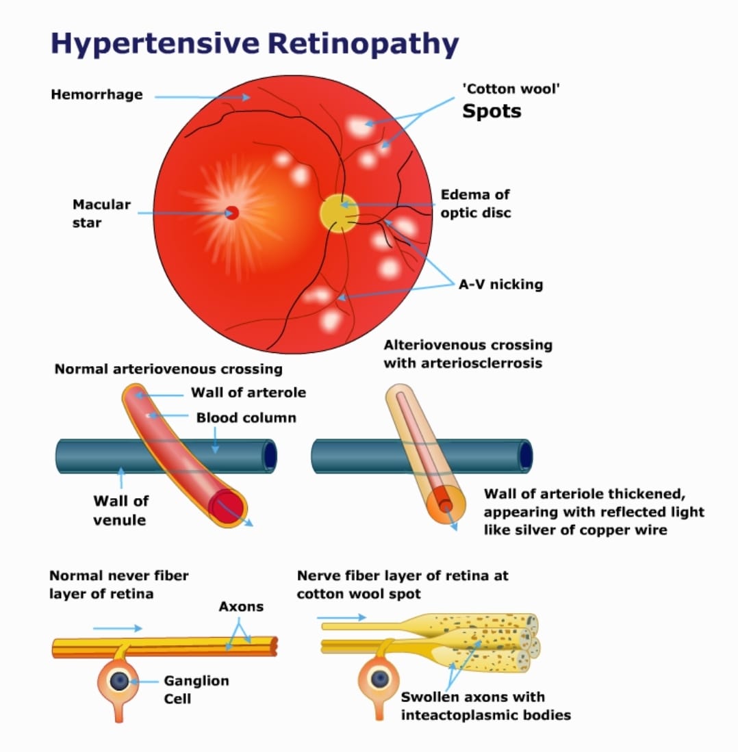 HYPERTENSIVE RETINOPATHY