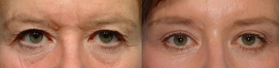 BLEPHAROPLASTY