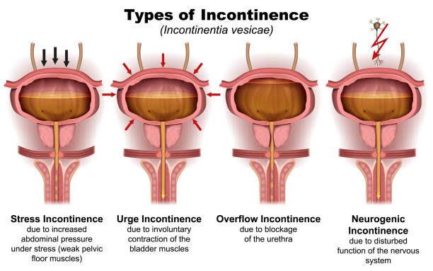 एस.यू.आय. (STRESS URINARY INCONTINENCE)