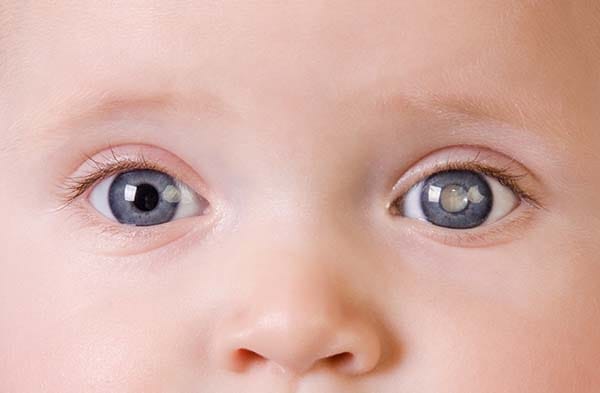 बालरोगतज्ञांसाठी मोतीबिंदू शस्त्रक्रिया (Pediatric Cataract Surgery)