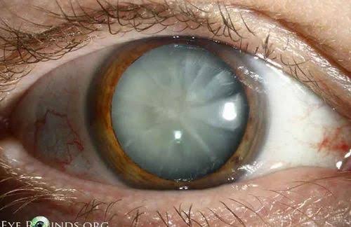 मोतीबिंदू (Cataract) आजार