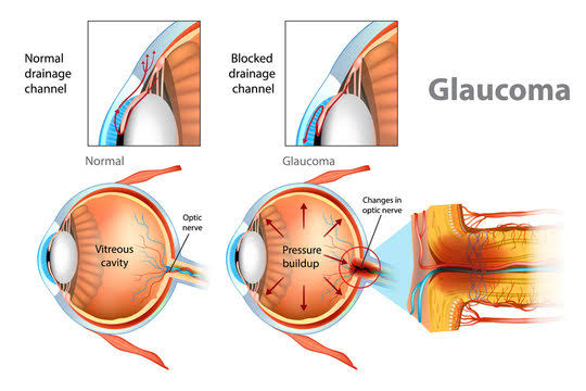 काचबिंदू (Glaucoma) आजार