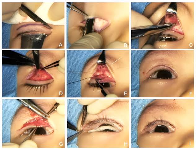 पापणीचे आजार व उपचार (Ptosis, Ectropion & Entropion Surgery)