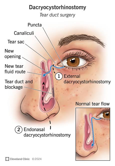 नासुरची शस्त्रक्रिया (Probing, DCR & Endonasal DCR)