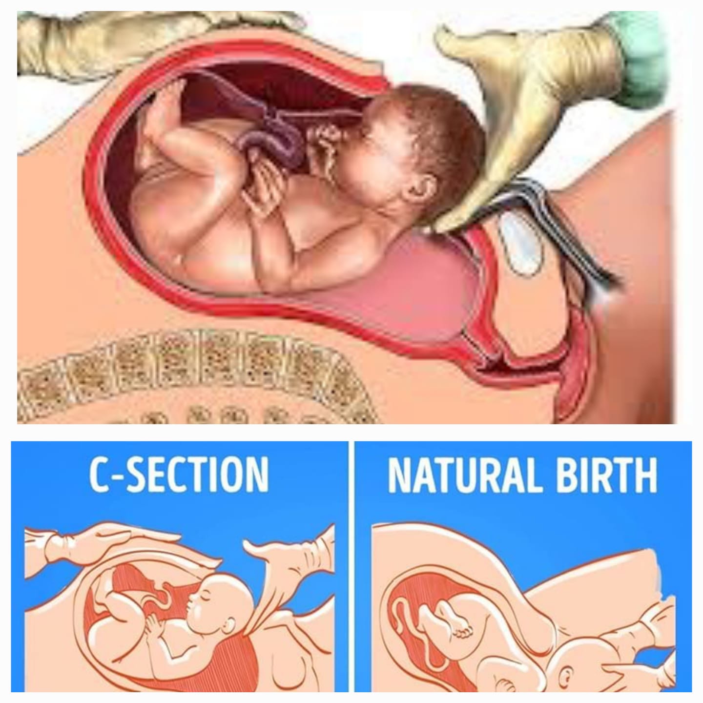 प्रसव (सामान्य व सिझेरियन)