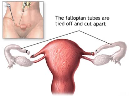 कुटुंबनियोजन शस्त्रक्रिया
