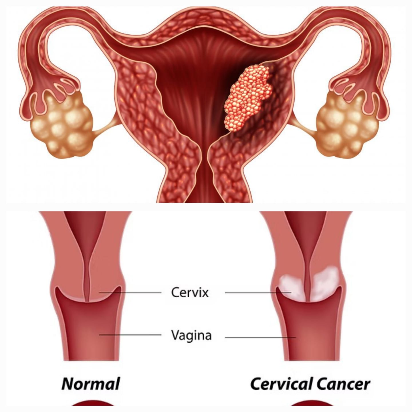 गर्भाशय व गर्भाशय मुखाचा कर्करोग