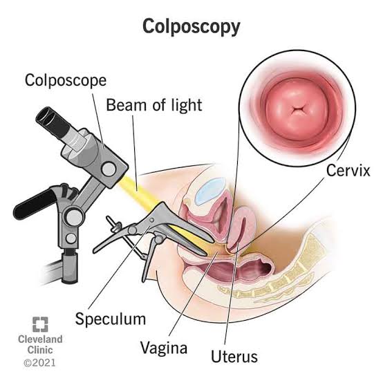 काॅल्पोस्कोपी (Colposcopy)
