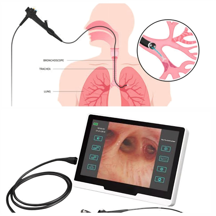 BRONCHOSCOPY (फुफ्फुसाचे दुर्बिण परिक्षण)