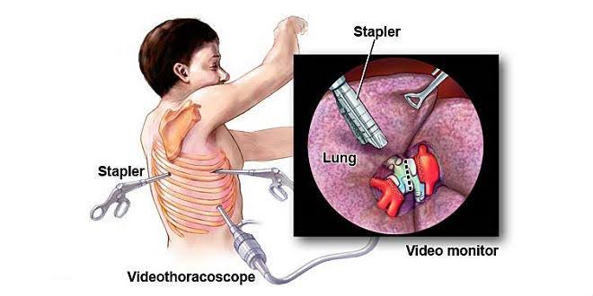 थोराकोस्कोपी (Thoracoscopy)