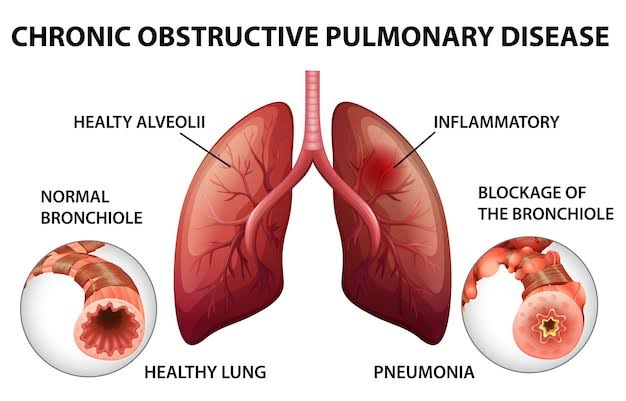COPD (जिर्ण आजारांचा दमा)