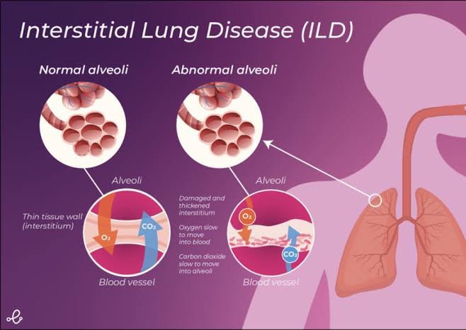 आंतरस्थ फुफ्फुस रोग (Interstitial Lung Disease - ILD)