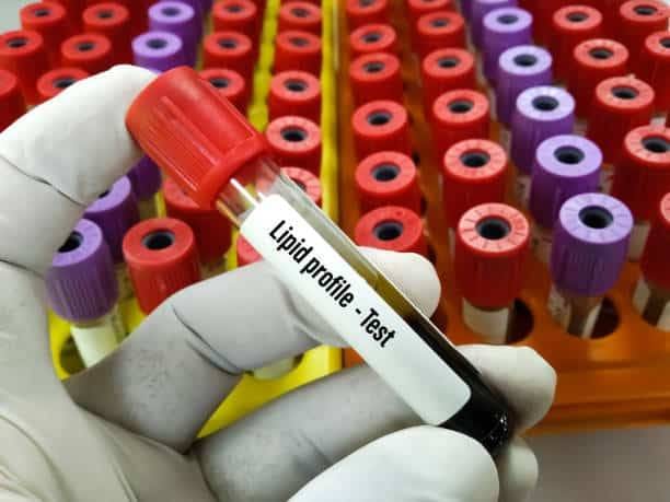 LIPID PROFILE TEST ( LPT )