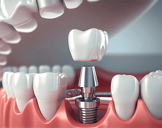 DENTAL IMPLANTS