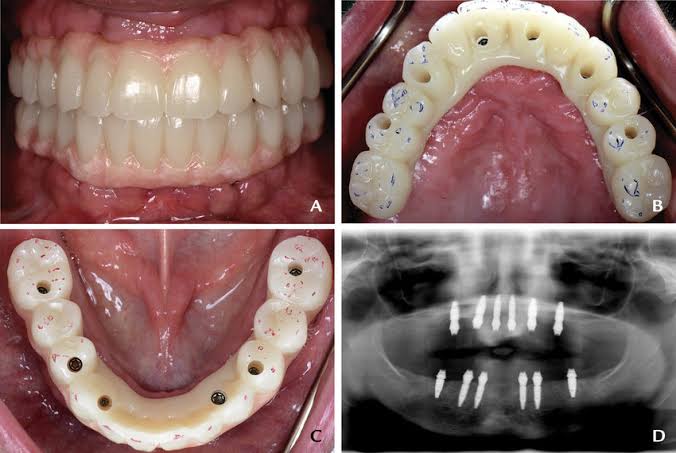FULL MOUTH REHABILITATION WITH IMPLANT