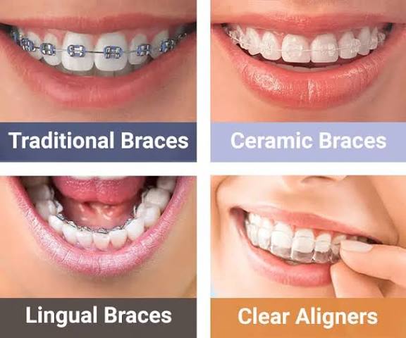 PROTRUDING, CROOKED TEETH AND GAPS BETWEEN TEETH