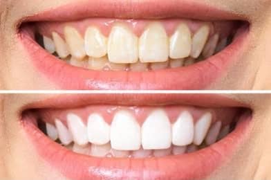 TEETH BLEACHING (TEETH WHITENING)