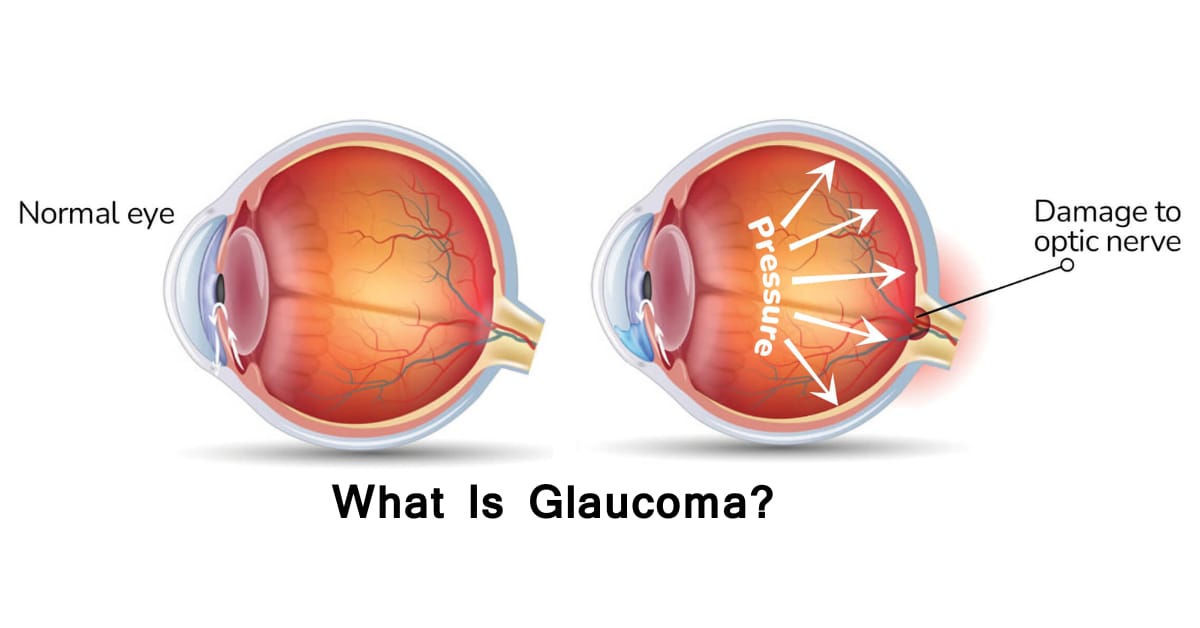 DIABETIC RETINOPATHY